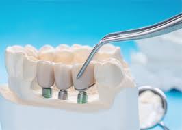 vật liệu nha khoa toàn quốc giá tốt