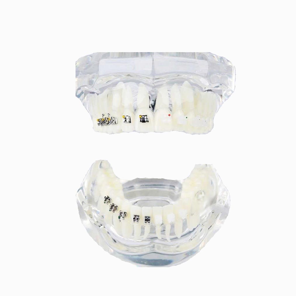 Mẫu Hàm Tư Vấn Chỉnh Nha 
